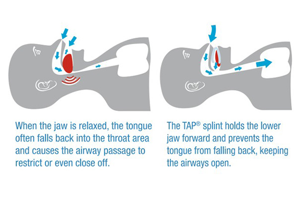Sleep Test (Polysomnography)